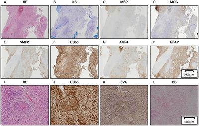 Case report: The histopathological analyses of two myelin oligodendrocyte glycoprotein antibody-associated diseases with a distinctive linear radiating gadolinium enhancement on MRI